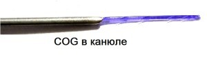 Мезонити с насечками на канюле