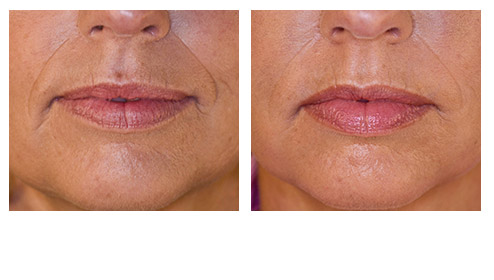juvederm-02.jpg
