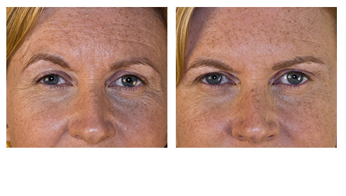 juvederm-01.jpg